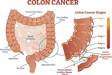Colorectal Cancer Surgery And Treatment The Surgical Clinic Tn