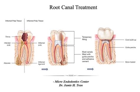 This can be for one of any of the complications outlines above. Root Canal Treatment - Micro Endodontics Center