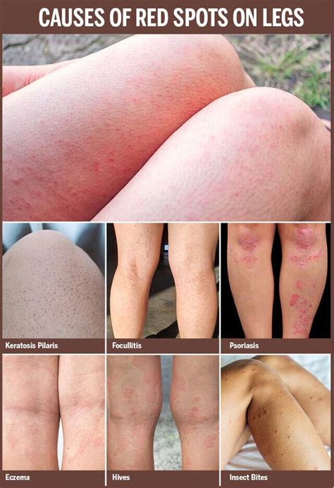 Light Brown Spots On Lower Legs Infoupdate Wallpaper Images