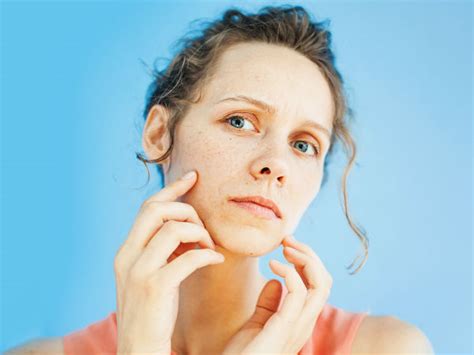 Common Skin Issues We All Face And Their Remedies