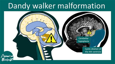 Dandy Walker Malformation Diagnosis Symptoms And Treatment Youtube