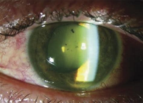 This is a much more rare form of glaucoma, which develops very quickly and demands immediate medical attention. Acute angle-closure glaucoma - WikEM