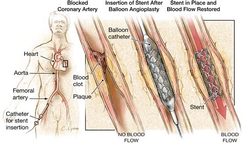 Stents To Treat Coronary Artery Blockages Cardiology Jama The