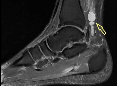 Aspiration Of Ganglion Cyst Is It Worth It Sport Doctor London