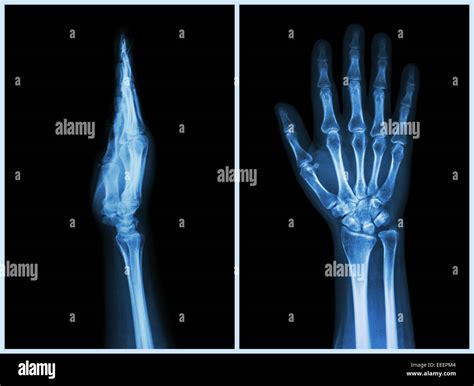 X Ray Hands Front And Side View Normal Human Hands Stock Photo Alamy