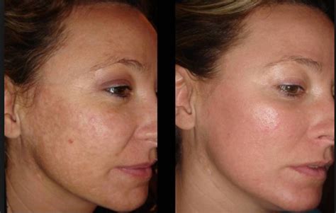 Ethos Spa Skin And Laser Centers Now Offering Advanced Fraxel Restore