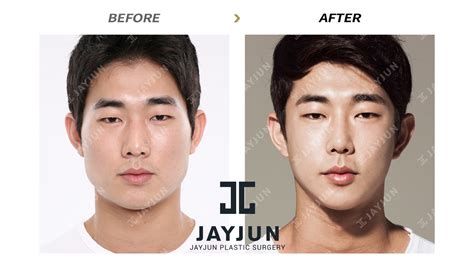 Best Korean Plastic Surgery Before And After Vrogue Co