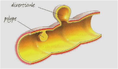 La péritonite est une affection médicale qui désigne l'enflure du péritoine, une membrane qui recouvre divers viscères de l'abdomen. Diverticulose et sigmoïdite diverticulaire | Récap' IDE