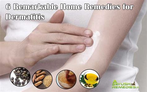 6 Home Remedies For Dermatitis On Face Scalp And Hands Home Remedies