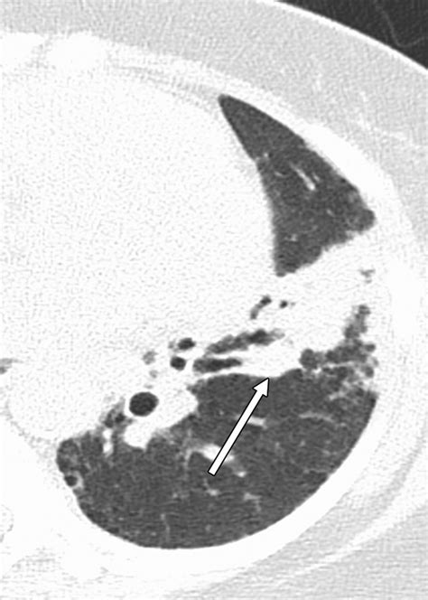 Lung Cancer Recurrence 18f Fdg Petct In Clinical Practice Ajr