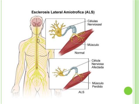 Haz tu pregunta y recibirás respuestas de expertos en esclerosis lateral amiotrófica y medicina familiar y comunitaria, medicina interna, neurología. Esclerosis Lateral Amiotrófica- Fundamentos de Investigación