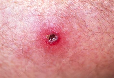 Tick bite - Stock Image - M320/0295 - Science Photo Library