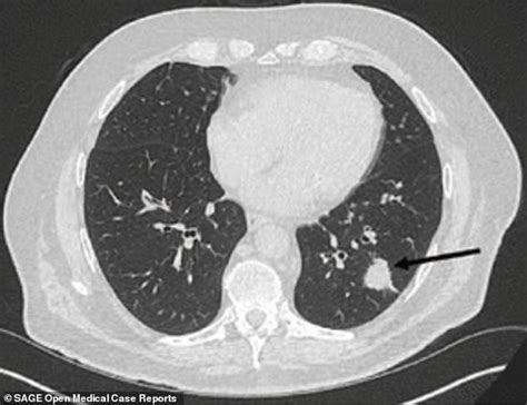 Ct scan for lung cancer. Lung Cancer Patient's Tumors Shrunk in Half After Using ...