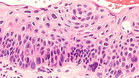 Squamous cell carcinoma (scc) is the second most common form of skin cancer. Squamous Cell Carcinoma In Situ of Anus