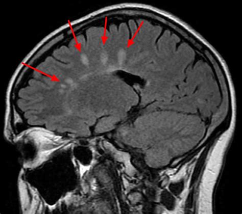 Brain Lesions Causes Brain Lesions Diagnosis And Brain Lesions Treatment