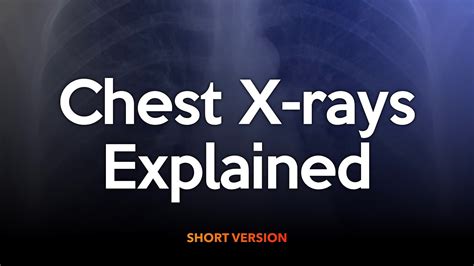 Chest X Rays Explained Short Version Youtube