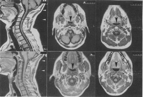 Magnetic Resonance Images Of The Pharynx In Two Normal Subjects The