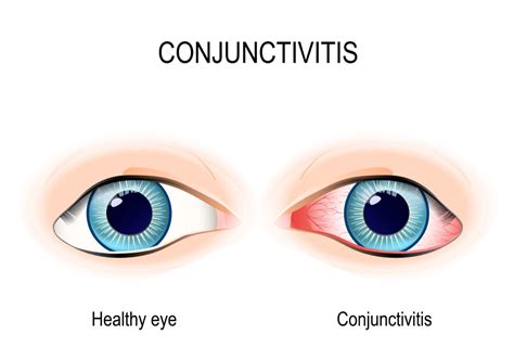 6 Things To Know About Conjunctivitis In Children Pink Eye Parental