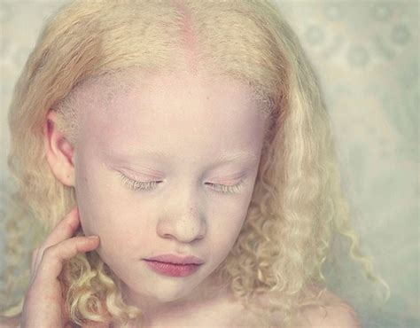 Unpigmented Photography Albinism Albino African Albino Girl