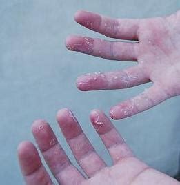 This happened before and got infected. About a week ago, I noticed the skin on my thumb was starting