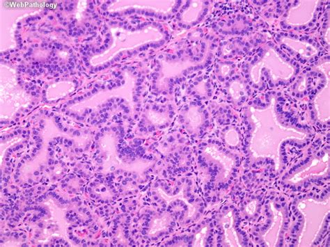 Hyperplasia Of Thyroid Gland