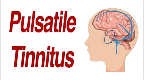 Pulsatile Tinnitus 7 Different Anatomic Causes Of Hearing Pulsations