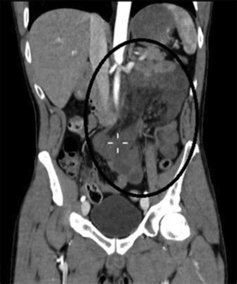 Axial Abdomen Ct Scan Shows A “cluster” Of Jejunal Loops In The