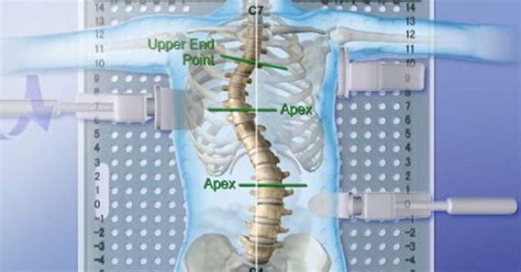 Spinal Tech The Providence Nocturnal Scoliosis System