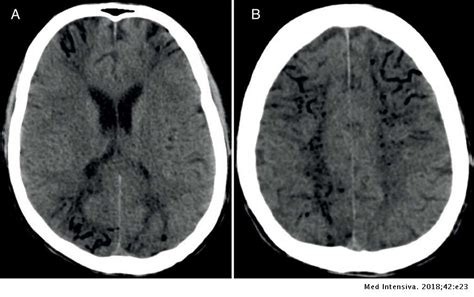 Los médicos aseguran que alan tiene muerte cerebral pero sus padres aseguran que el joven aún reacciona cuándo se le habla. Embolia grasa cerebral masiva tardía secundaria a ...