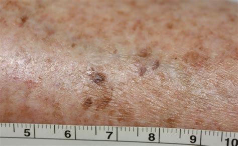 Diabetic Dry Skin Pictures Symptoms And Pictures
