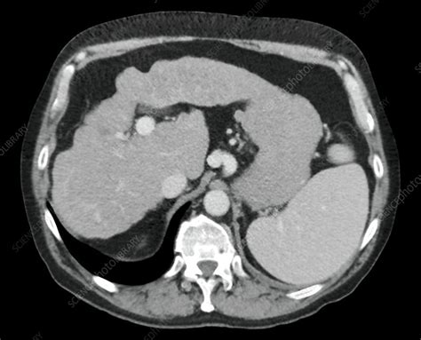 Liver Cirrhosis Ct Scan Stock Image C0215464 Science Photo Library