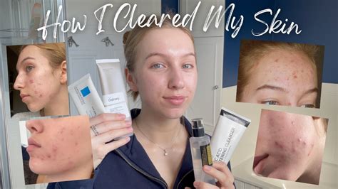 The Skincare Routine That Actually Cleared My Acne No Accutane 🤍