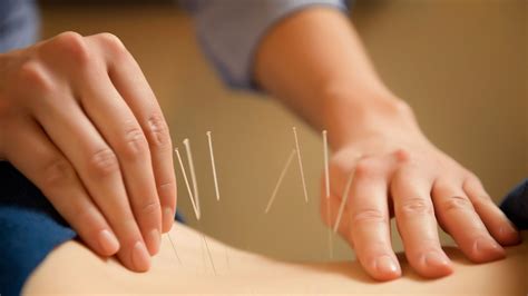 Clinics That Offer Acupuncture Treatment The Health Blog Fidoc