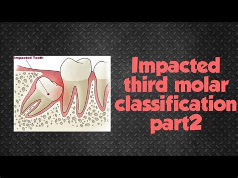 Relation of the tooth to the ramus of the mandible and the second molar Impacted third molar classification part2 | pell and ...