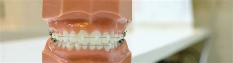 May 06, 2021 · to determine if you need braces, smile and look at your teeth in a mirror. How do I know if I need braces?