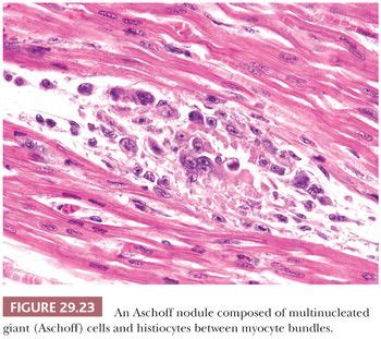 Recurrent warty endocarditis of mitral valve in rheumatism. Heart | Basicmedical Key