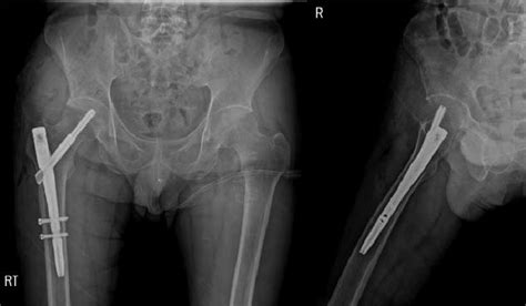 The greater trochanter is lower extremity of right femur viewed from below. In order to prevent further fractures of the right lesser ...