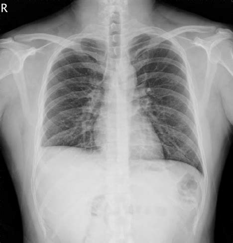 Chest Radiograph Showing Resolution Of Pleural Effusion With Mild