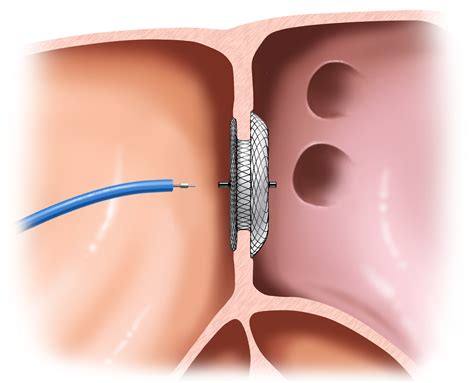 Patent Foramen Ovaleatrial Septal Defectventricular
