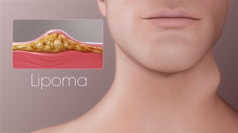 Get Rid Of Lipoma Symptoms Home Remedies And Herbal Treatments
