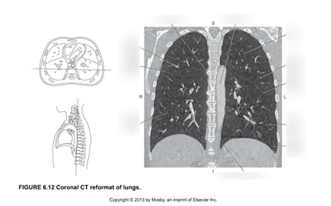 Coronal Ct Reformat Of Lungs Diagram Quizlet