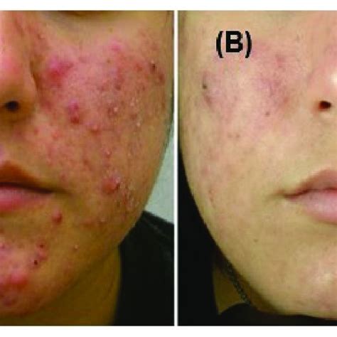 Acne Treatment With Blue Light And Endogenous 5 Aminolevulinic Acid