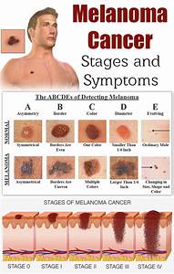 It Is Only Skin Cancer - Life and Linda Skin Cancer  