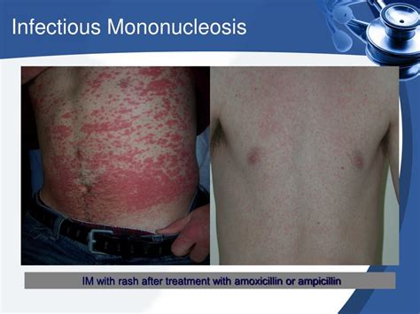 Mononucleosis Rash 2 Learn About Mono Symptoms Treatment And