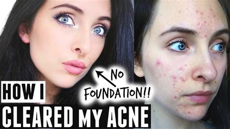 How I Cleared My Skin And Marks My Acne Story Products Youtube
