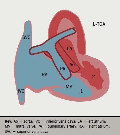 The exception is when responder holds a good suit that can't be directly bid over the. Pacing in patients with congenital heart disease: part 2 ...