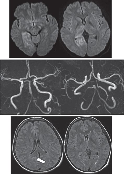 Magnetic Resonance Imaging On Admission Diffusion Weighted Imaging Download Scientific Diagram