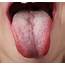 Do You Have Oral Thrush Or Just White Tongue