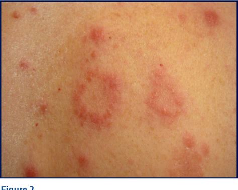 Figure 2 From Herpes Zoster Associated Erythema Multiforme
