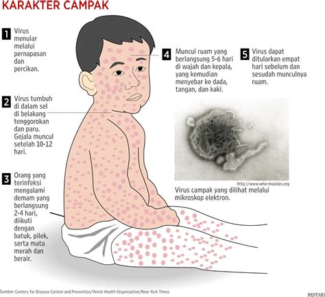 Apa Penyebab Gejala Penyakit Campak? - Macam Penyakit